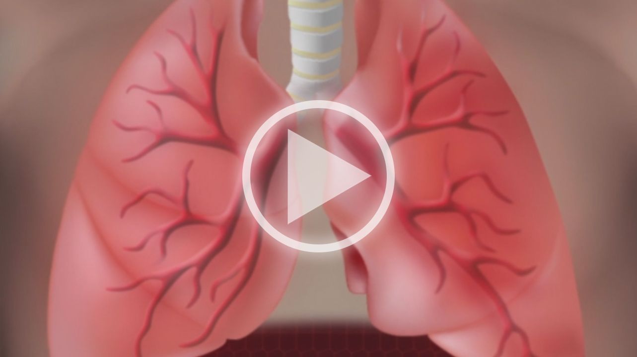 Asthma