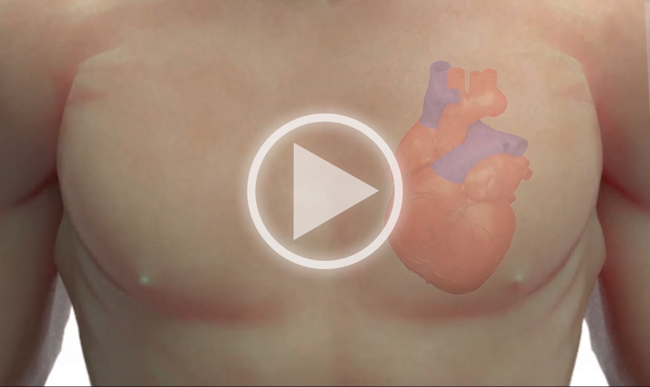 Bradycardia (BRAD)
